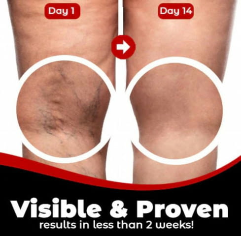 Пластири за варикозни вени - град Пловдив | Други - снимка 4