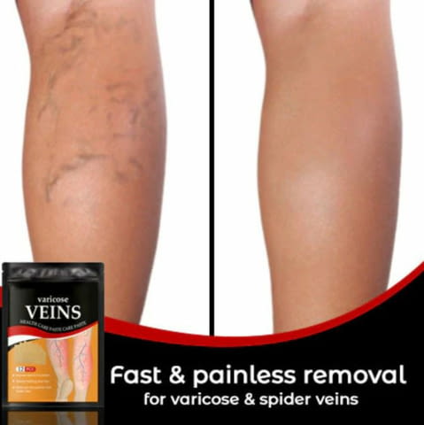 Пластири за варикозни вени - град Пловдив | Други - снимка 5