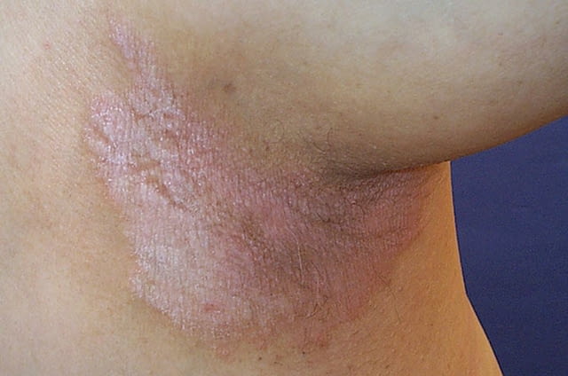 Крем Yiganerjing за псориазис, екземи, град София | Традиционна / Народна Медицина - снимка 4