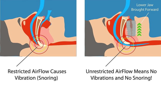Шина назъбник за уста против хъркане No More Snore, град София | Помощни Средства - снимка 2